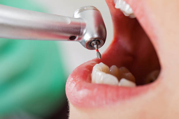 Best Knocked-Out Tooth Emergency  in San Jose, CA